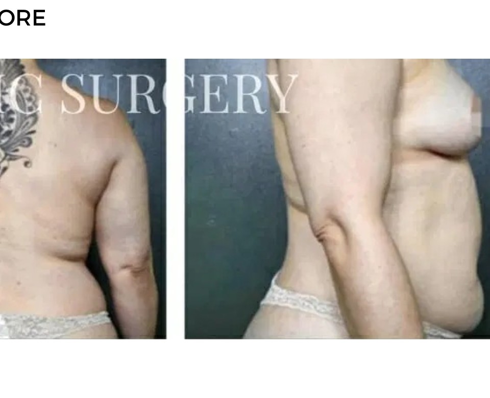 Procedure before and after - after