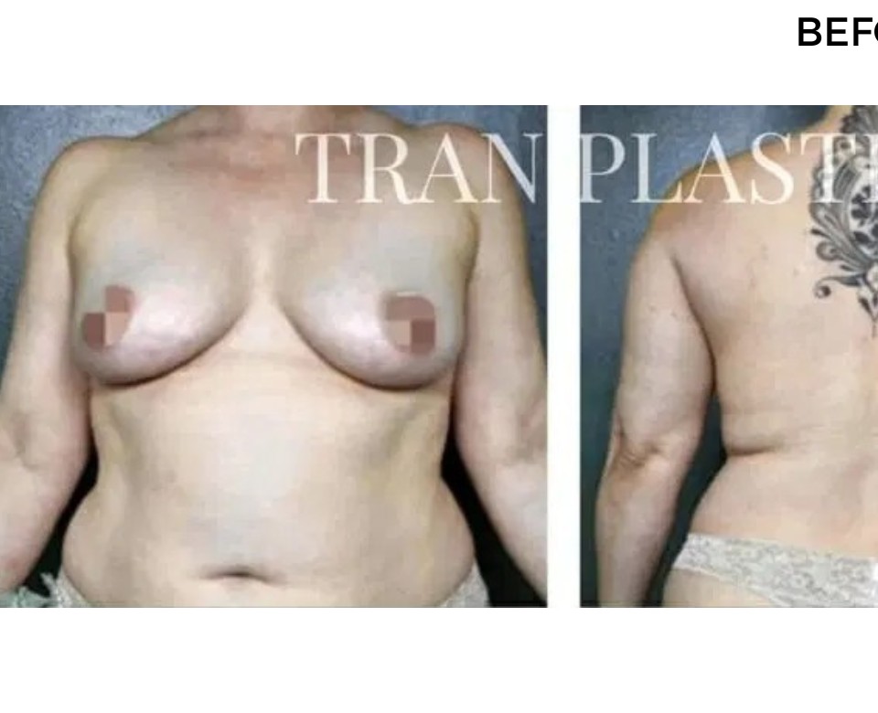 Procedure before and after - before