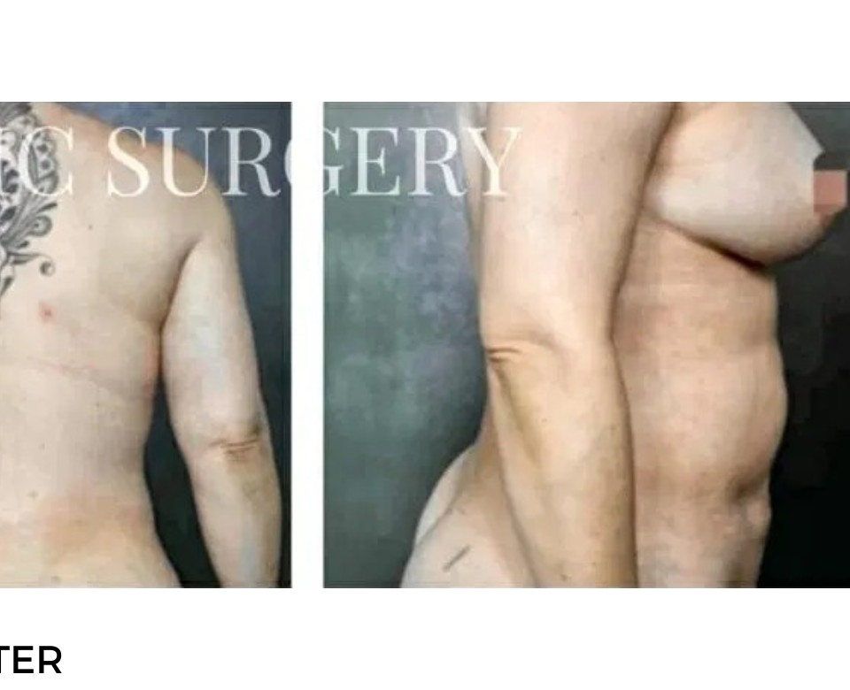 Procedure before and after - after