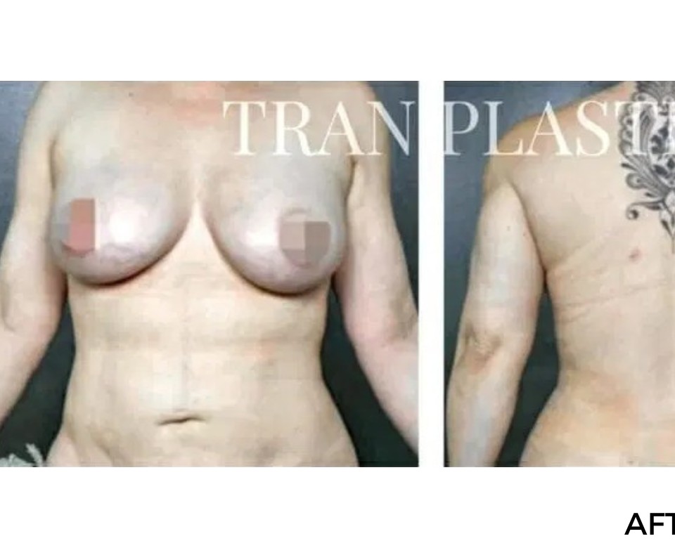 Procedure before and after - before