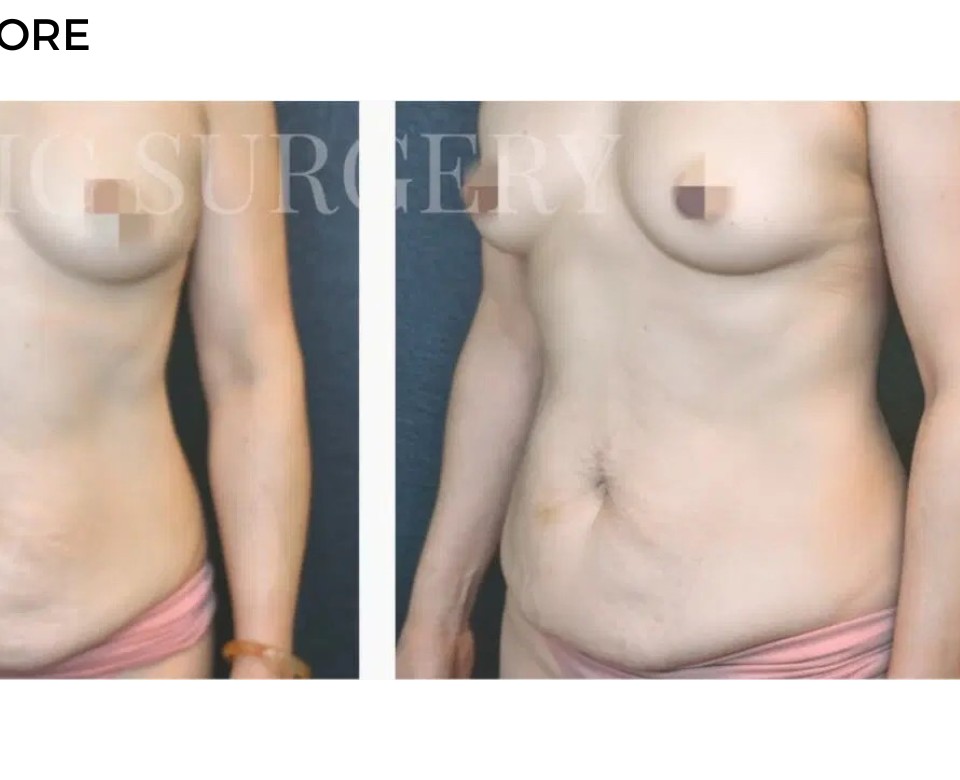 Procedure before and after - after