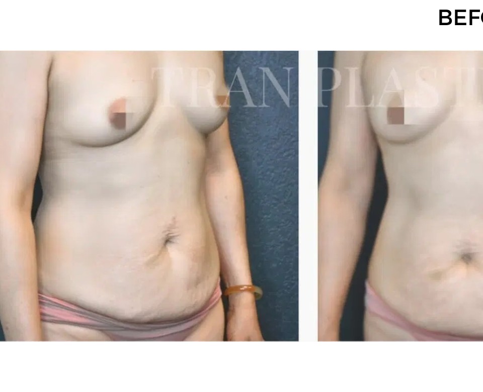 Procedure before and after - before