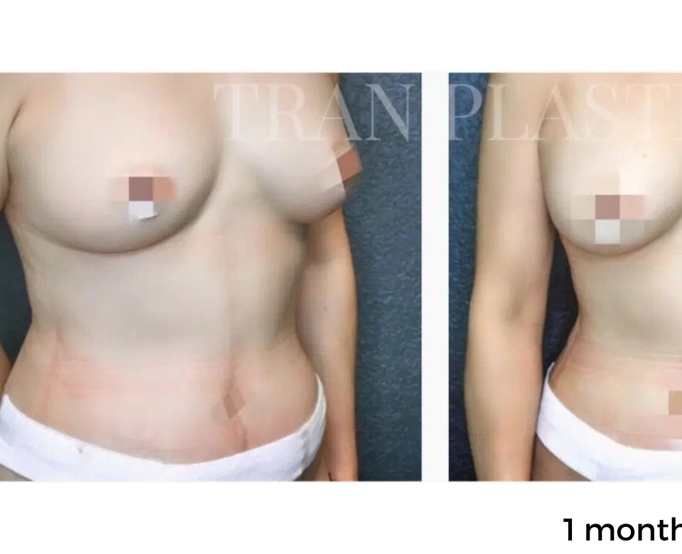 Procedure before and after - before