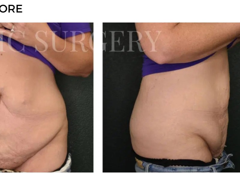 Procedure before and after - after