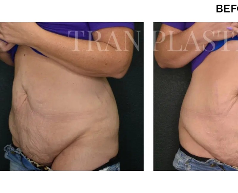 Procedure before and after - before