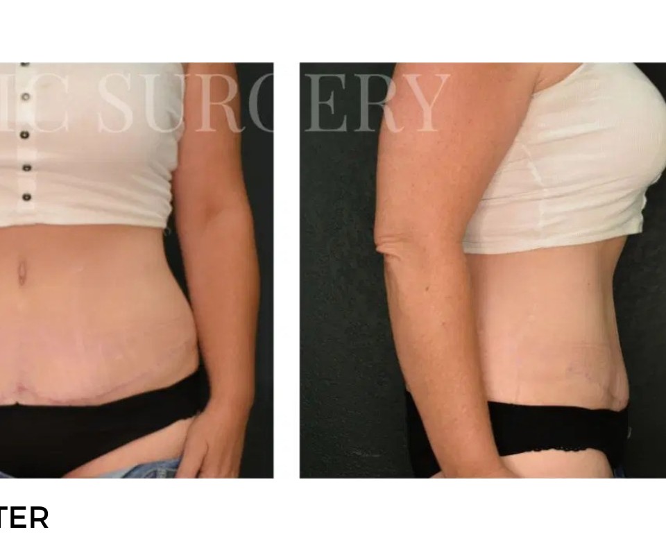 Procedure before and after - after