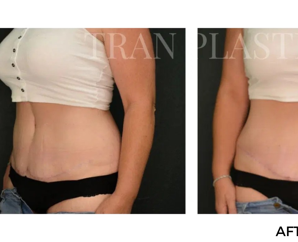Procedure before and after - before