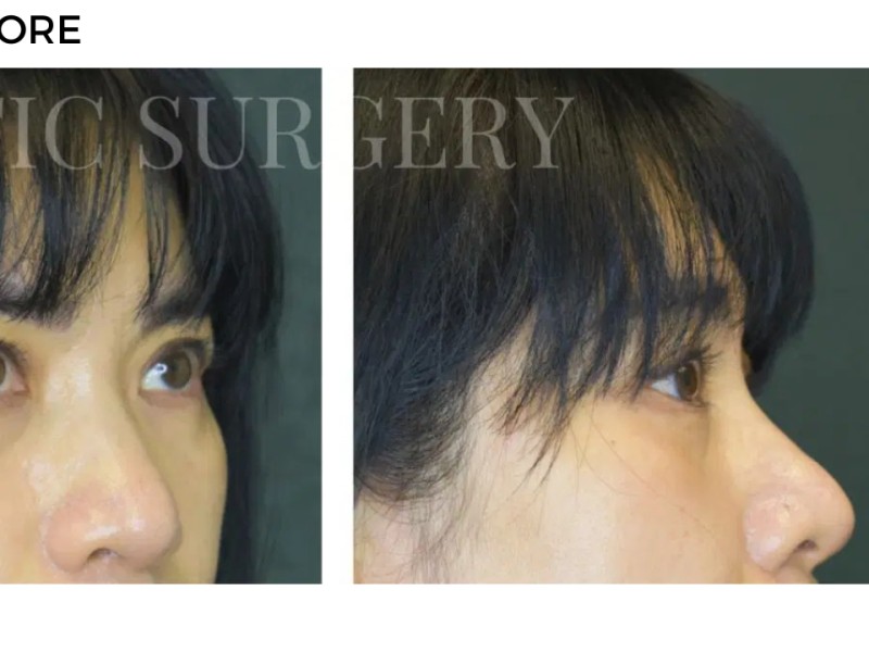 Procedure before and after - after