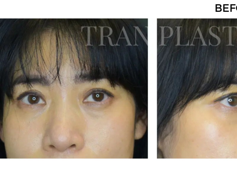 Procedure before and after - before