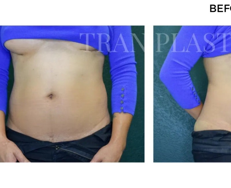 Procedure before and after - before