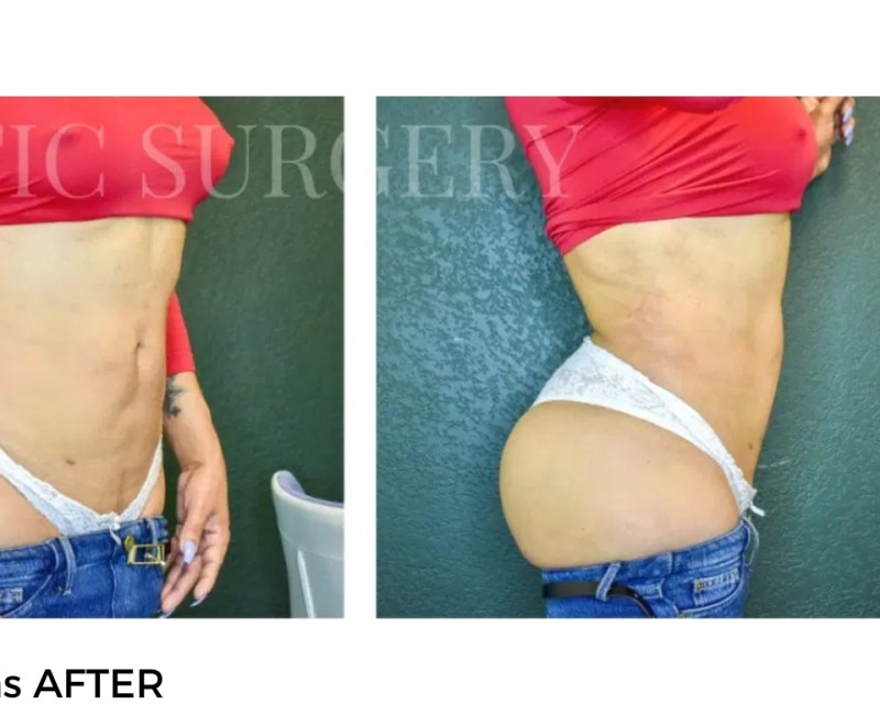 Procedure before and after - after