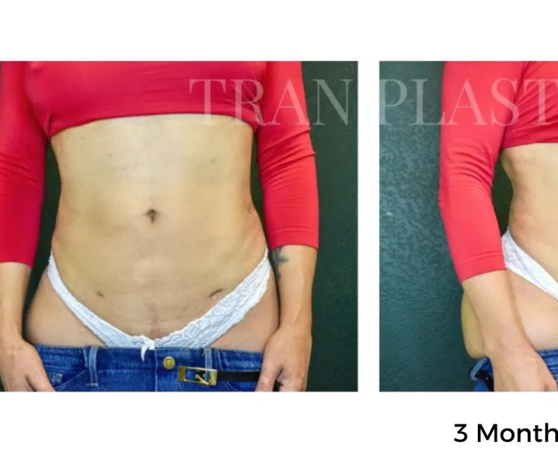 Procedure before and after - before