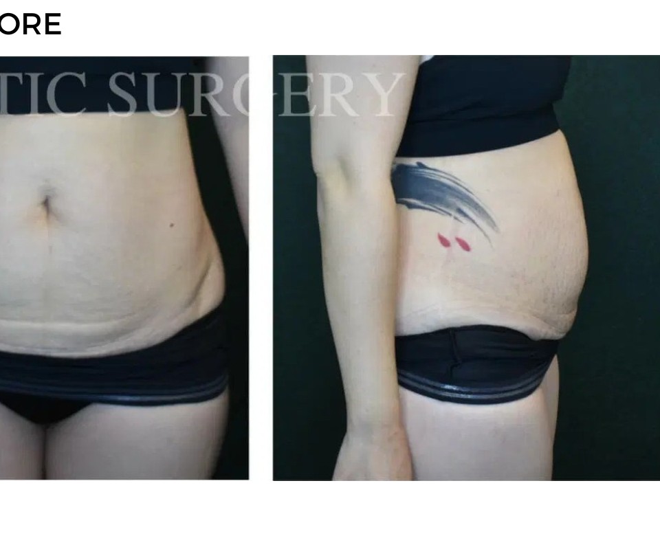 Procedure before and after - after