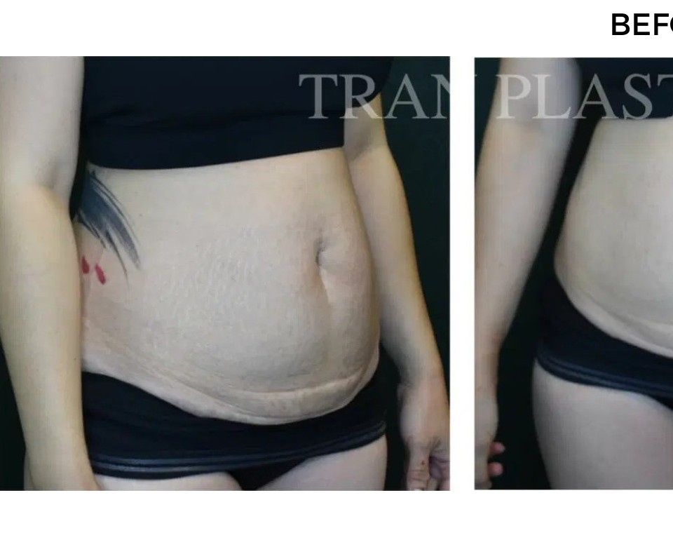 Procedure before and after - before