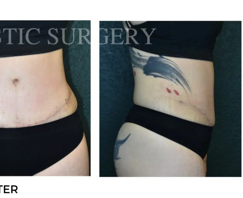 Procedure before and after - after