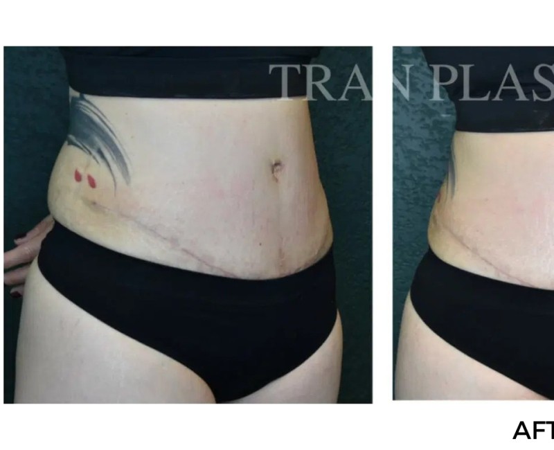 Procedure before and after - before