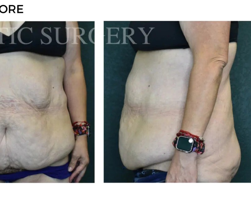 Procedure before and after - after