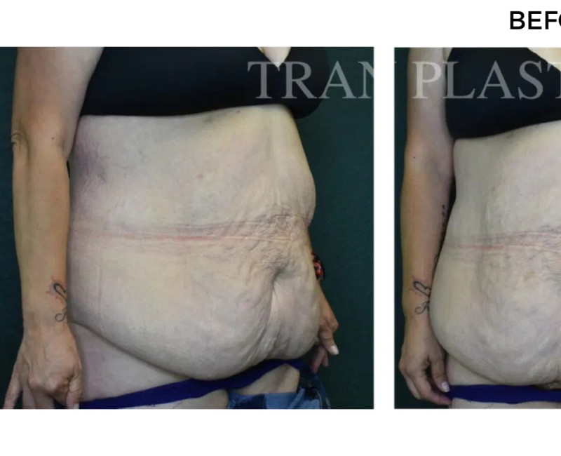 Procedure before and after - before