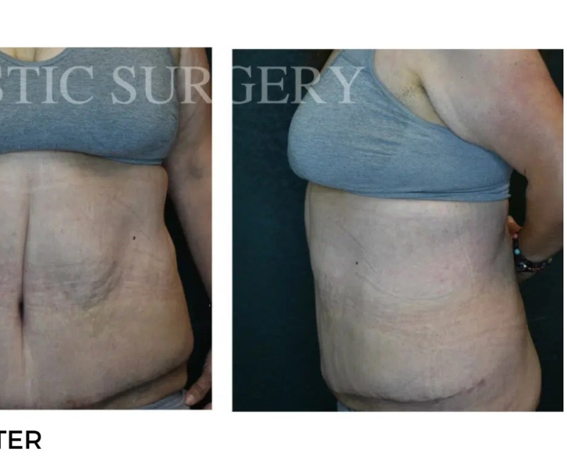 Procedure before and after - after