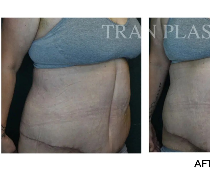 Procedure before and after - before