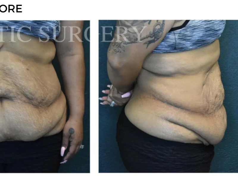 Procedure before and after - after