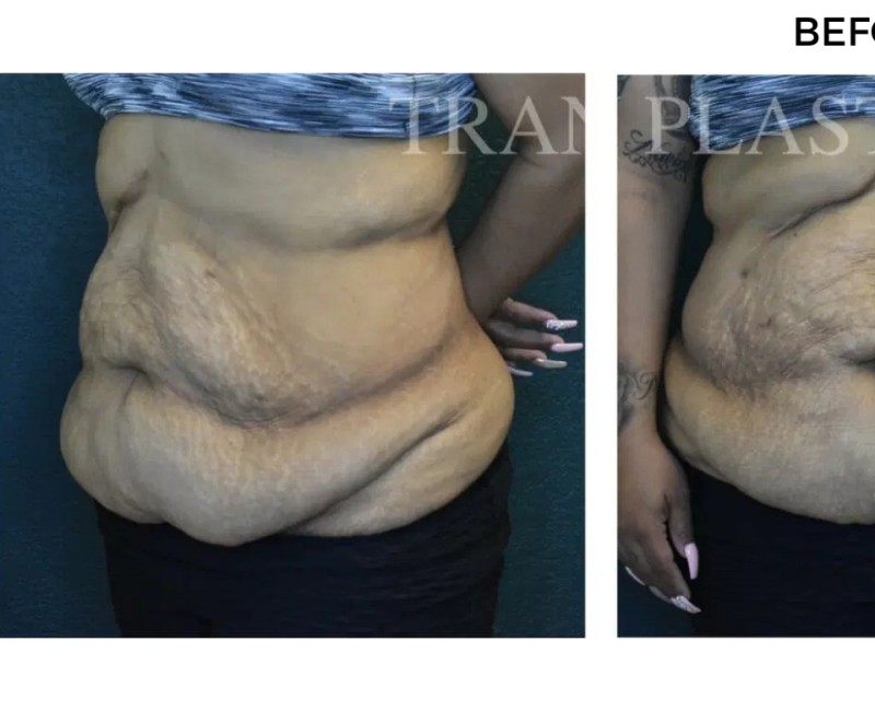 Procedure before and after - before