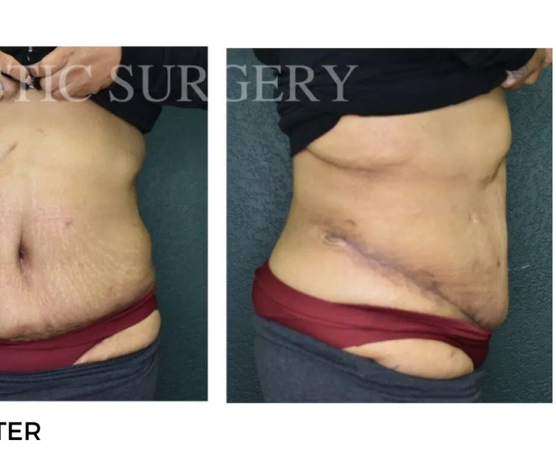 Procedure before and after - after