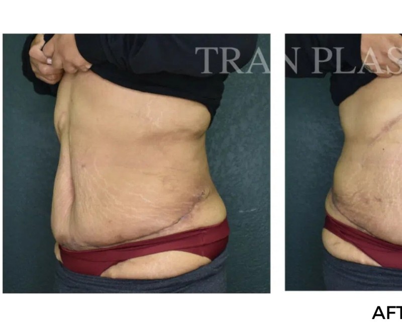 Procedure before and after - before