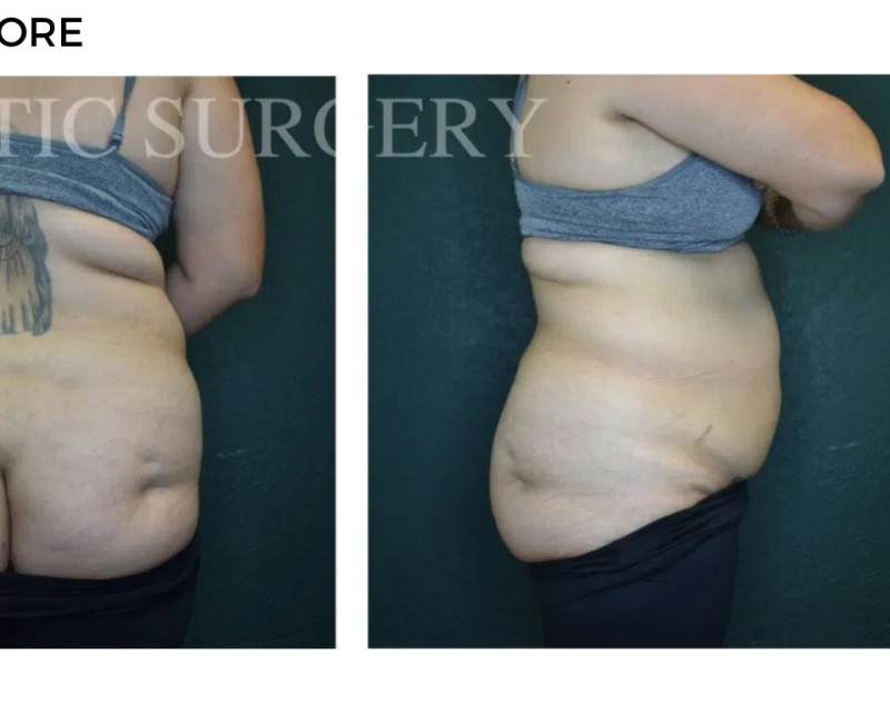 Procedure before and after - after