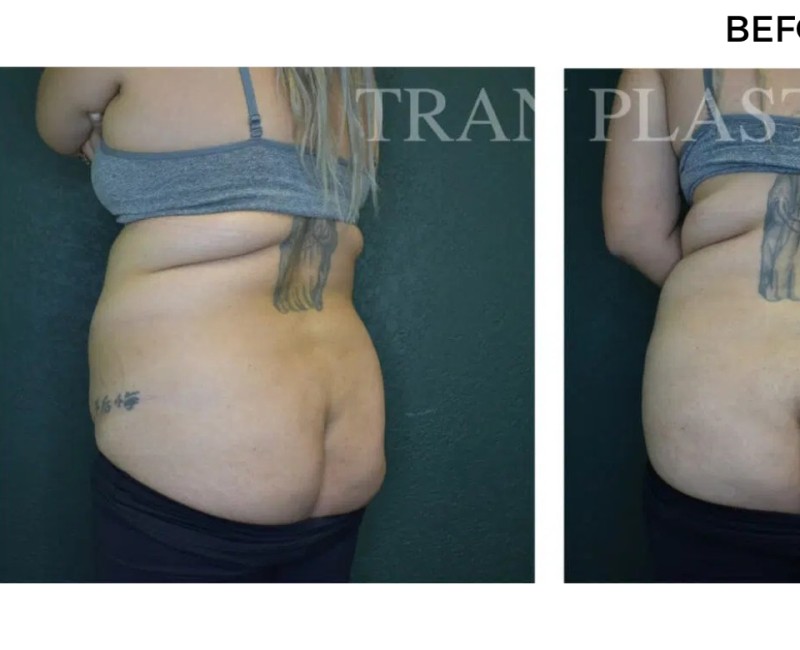 Procedure before and after - before