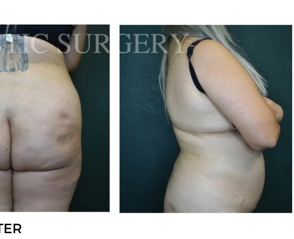 Procedure before and after - after