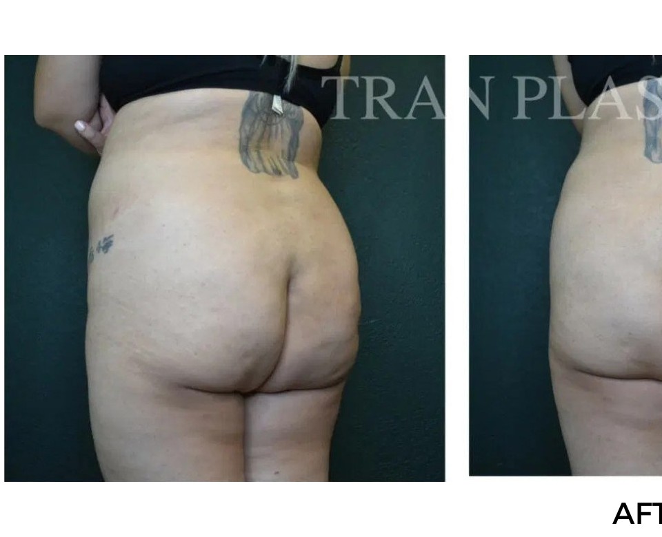 Procedure before and after - before