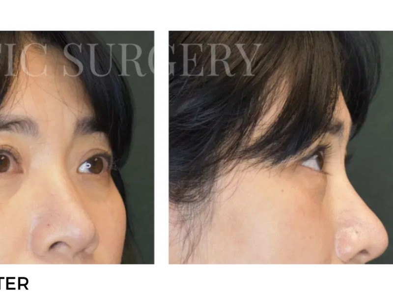 Procedure before and after - after