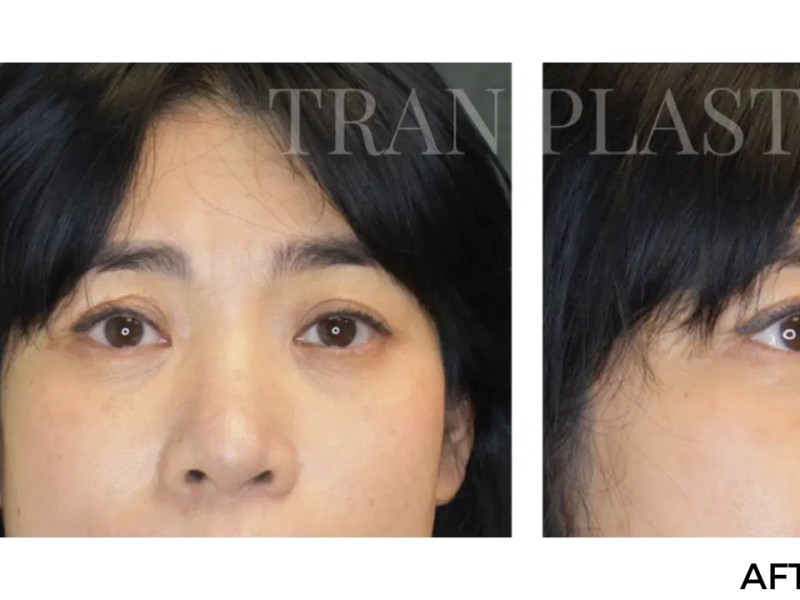 Procedure before and after - before