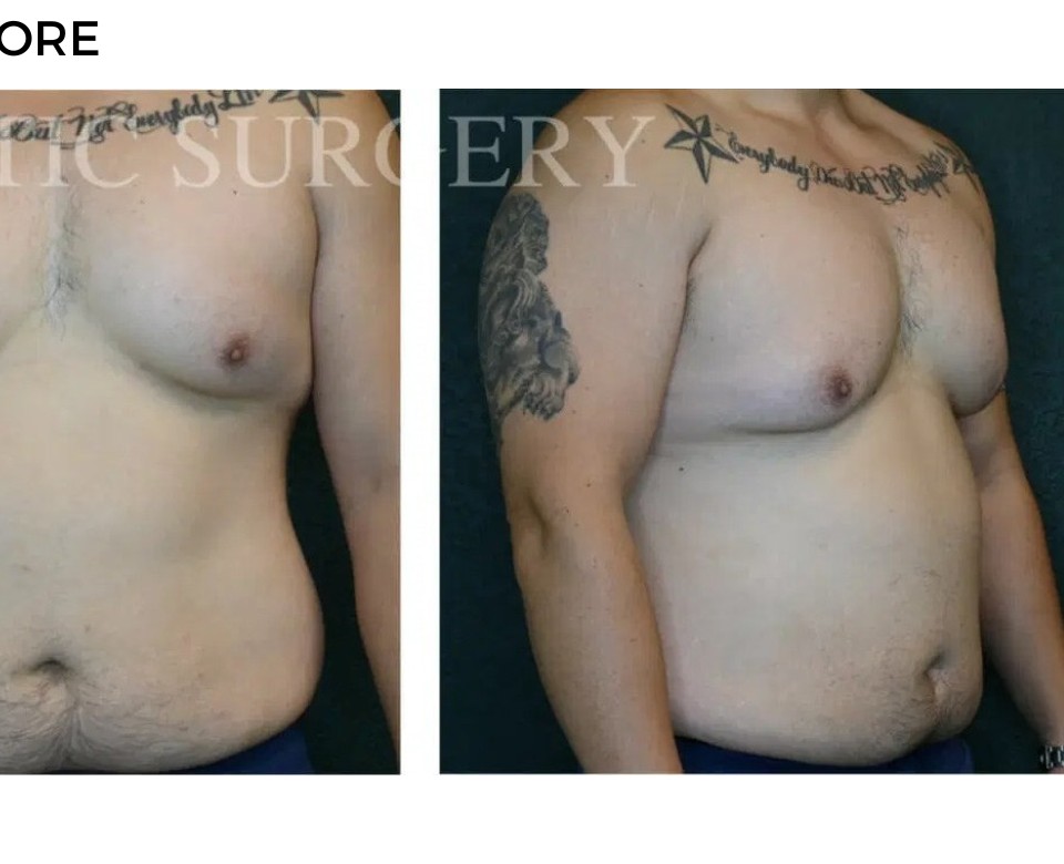 Procedure before and after - after