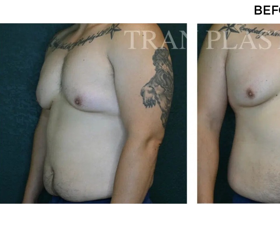 Procedure before and after - before