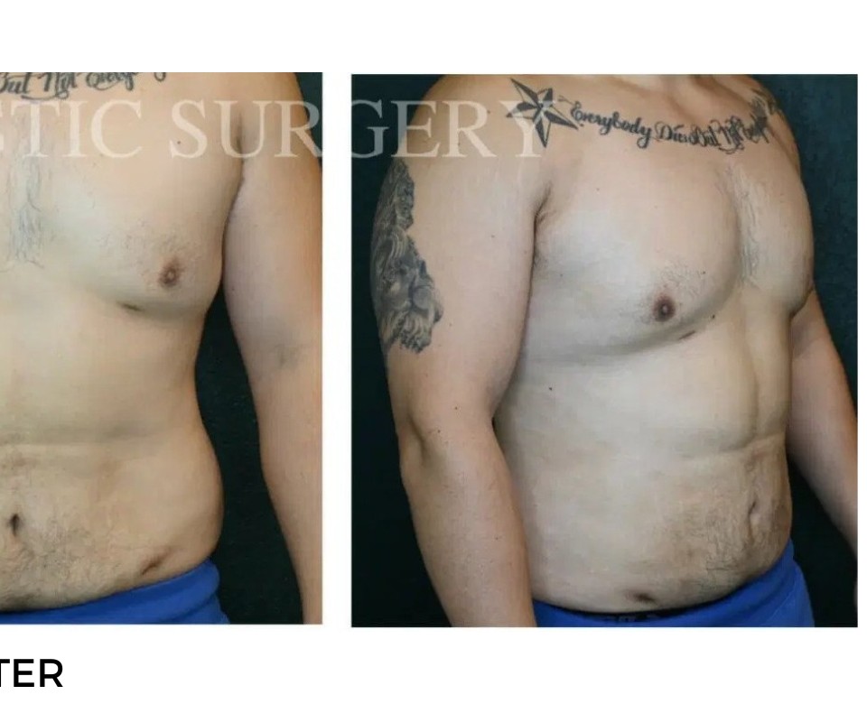 Procedure before and after - after