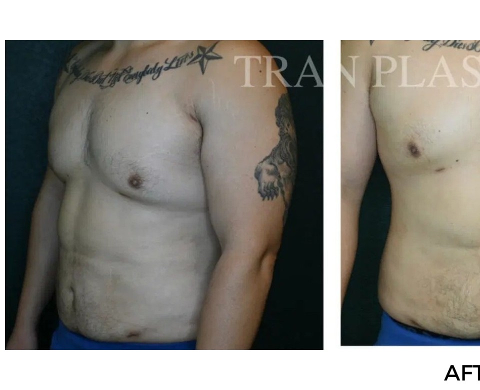Procedure before and after - before