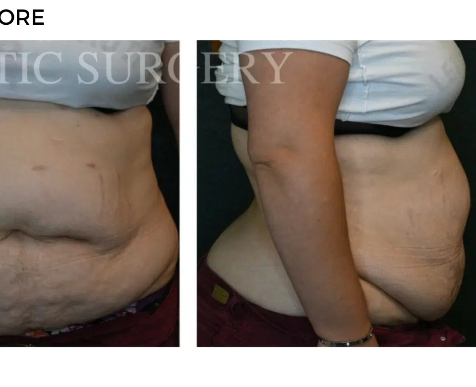 Procedure before and after - after