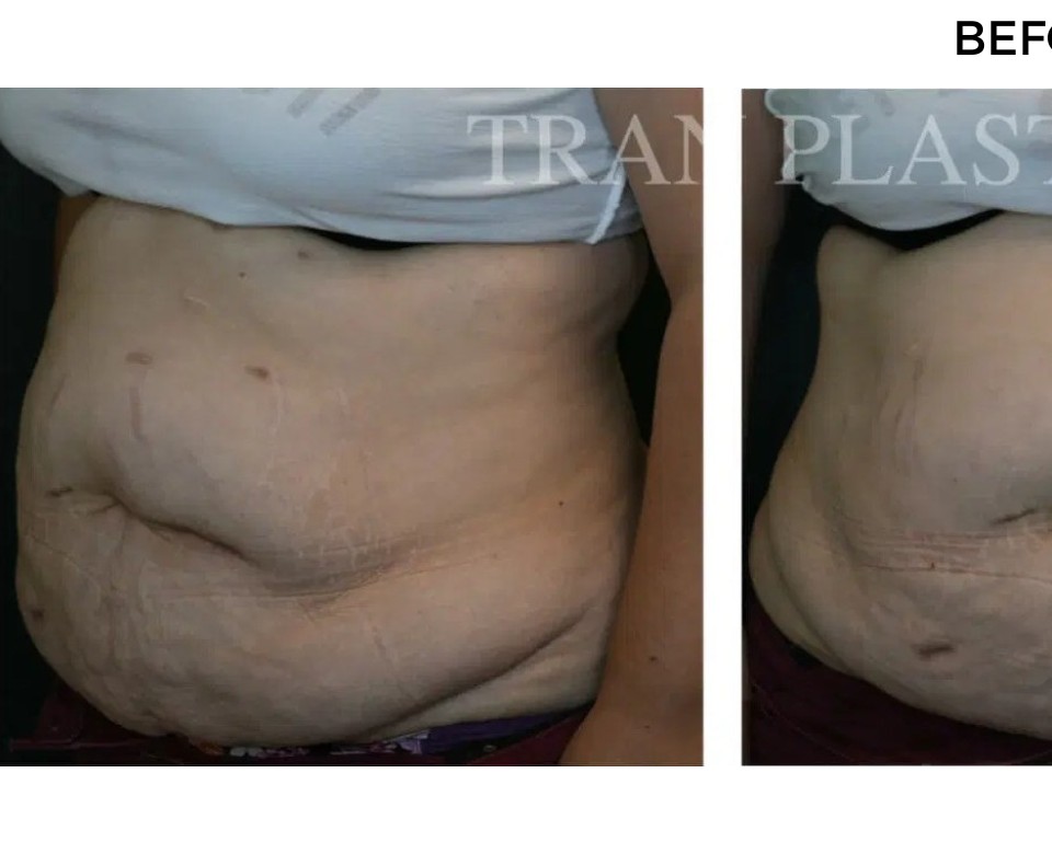Procedure before and after - before