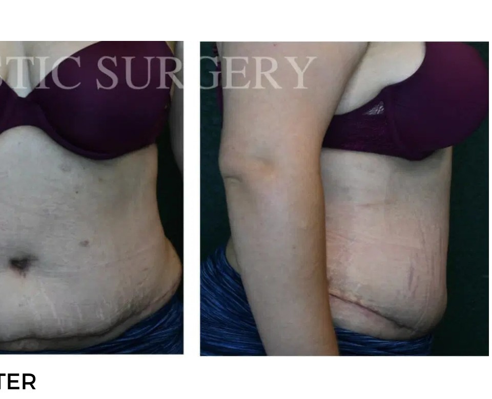 Procedure before and after - after