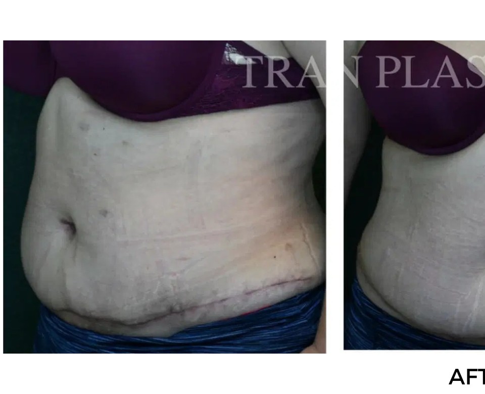 Procedure before and after - before
