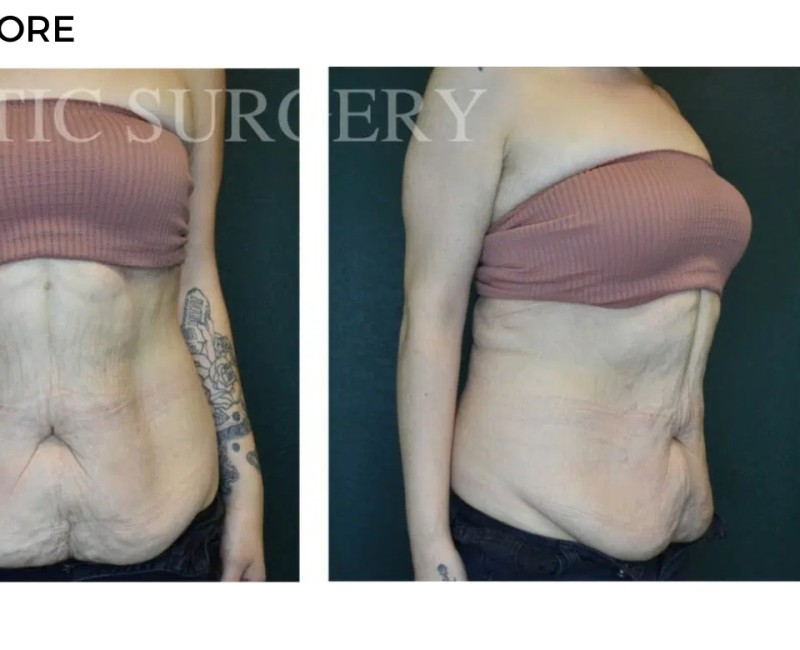 Procedure before and after - after