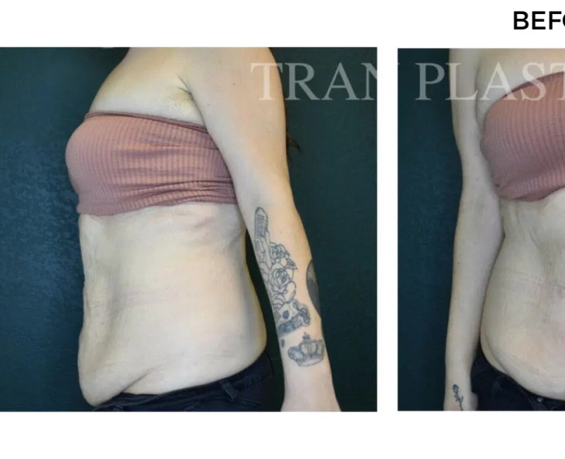 Procedure before and after - before
