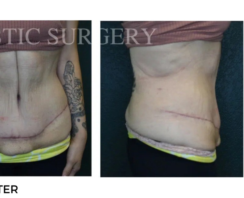 Procedure before and after - after