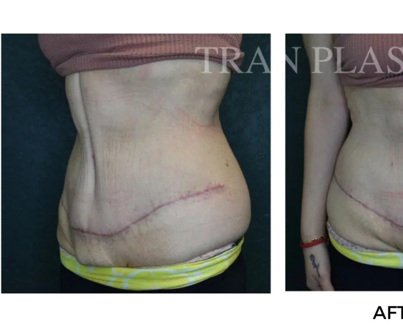 Procedure before and after - before