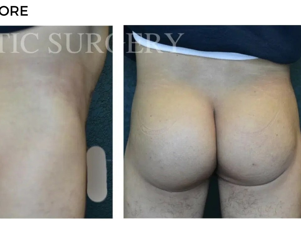 Procedure before and after - after