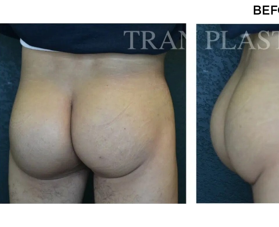 Procedure before and after - before