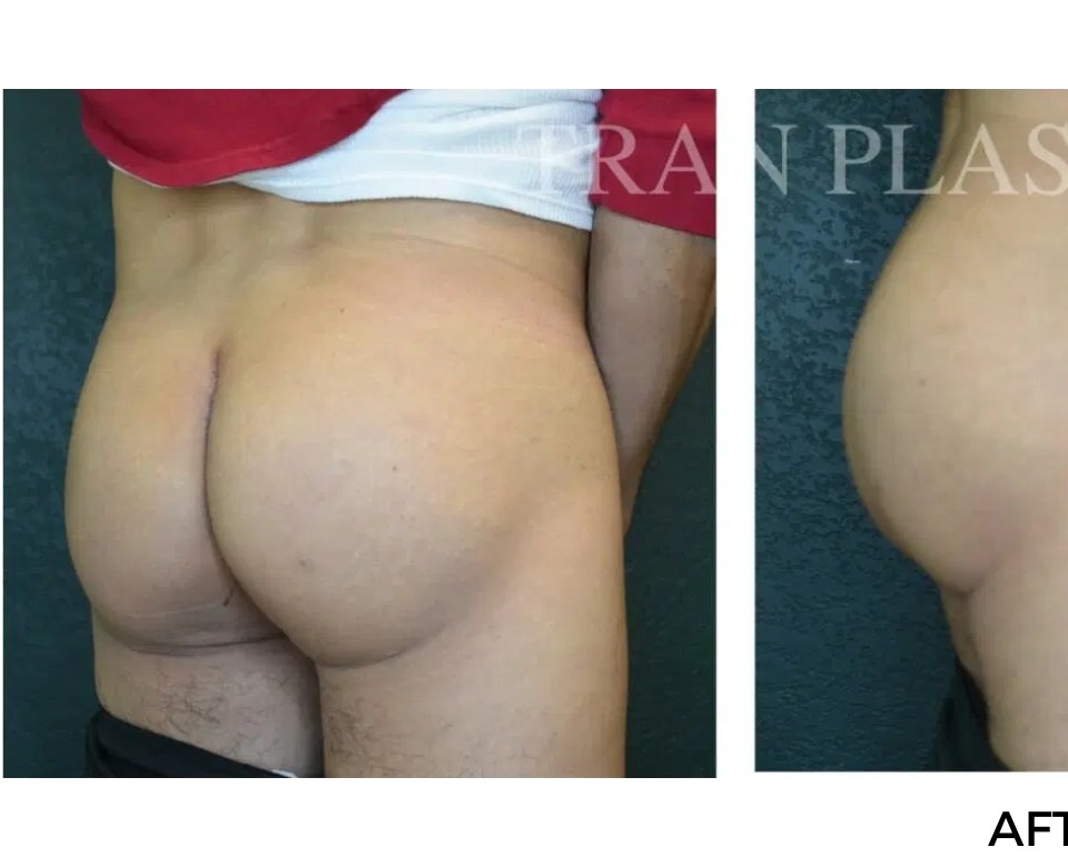 Procedure before and after - before