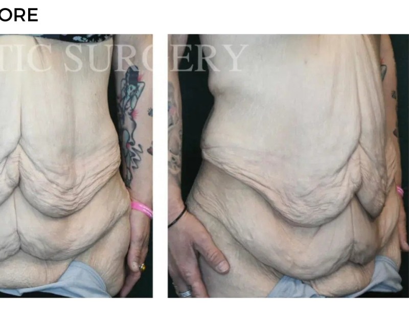 Procedure before and after - after